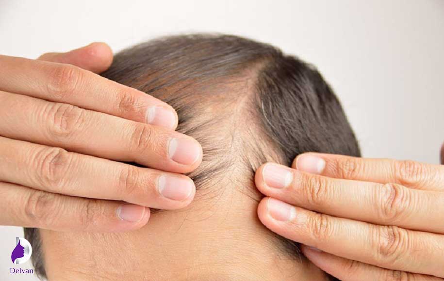 آیا کاشت مو با روش نیوگرافت اثربخش است؟