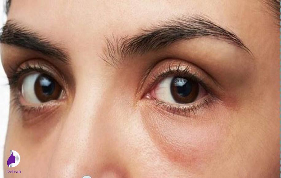 درمان ورم چشم بعد از کاشت ابرو