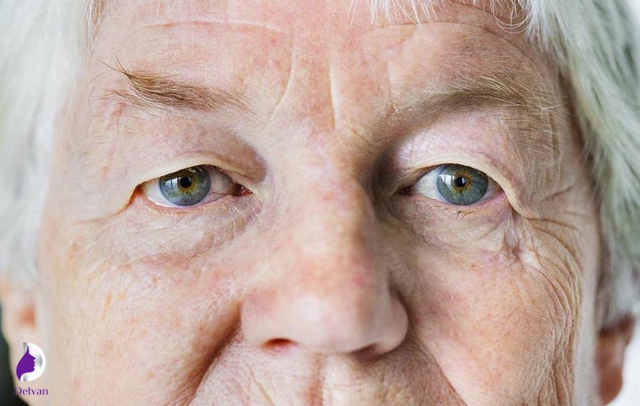 تاثیر افزایش سن در کوچک شدن چشم بعد از عمل بلفاروپلاستی