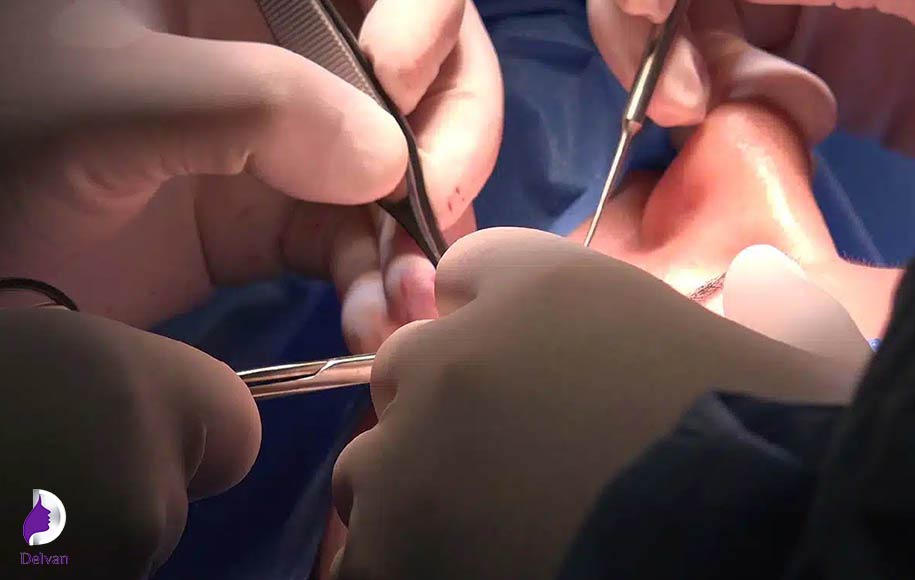 جراحی پتوز چیست؟