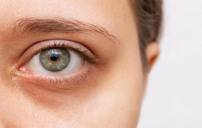 علت کوچک شدن چشم بعد از بلفاروپلاستی و راه‌های درمان