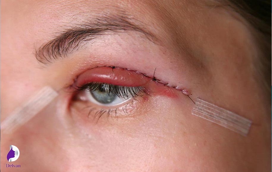علت کوچک شدن چشم بعد از بلفاروپلاستی به دلیل پف چشم
