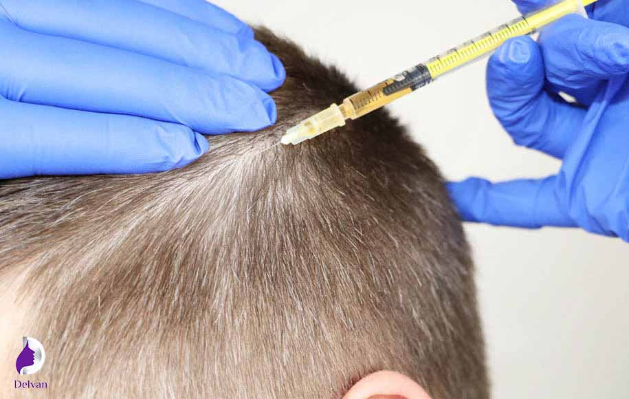 آیا مزوتراپی مو عوارض جانبی خاصی دارد؟