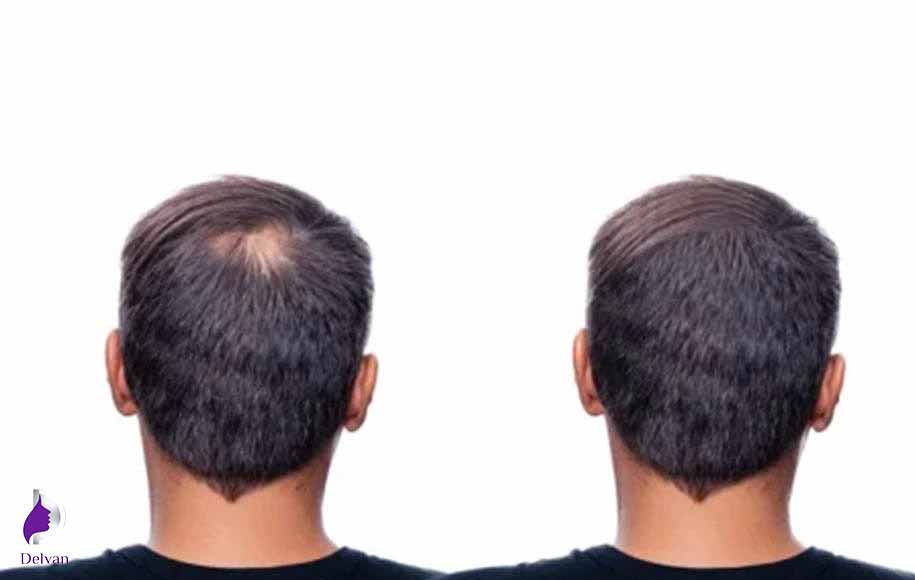 رشد موهای پیوند شده بعد از 6 تا 7 ماه