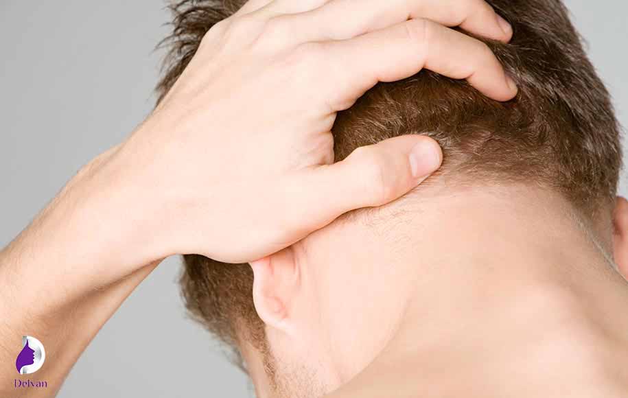 علت سردرد بعد از کاشت مو