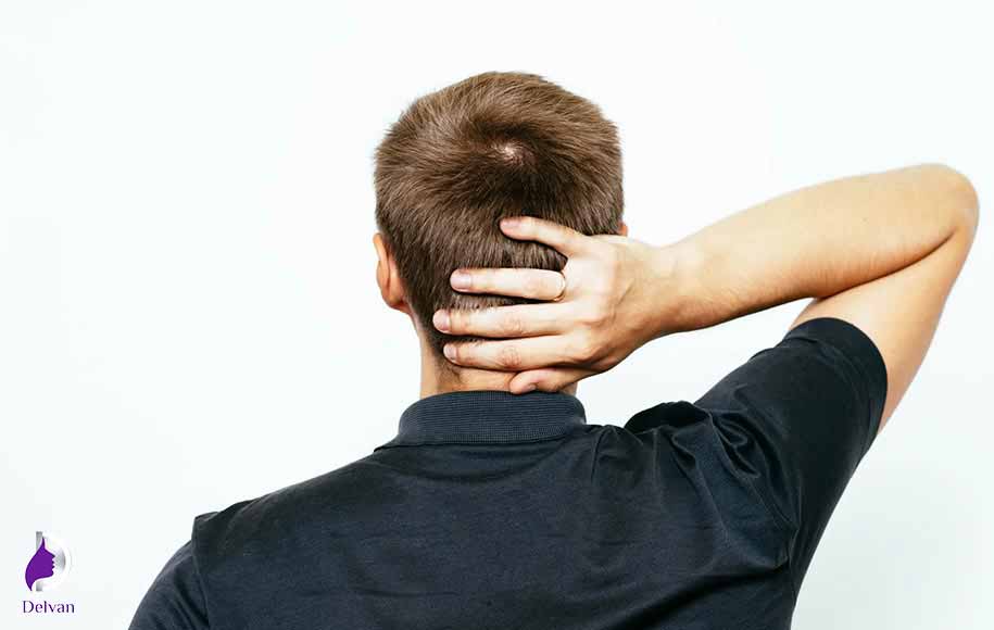 علت سردرد بعد از کاشت مو